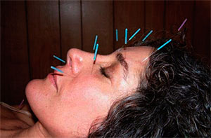 acupuntura facial