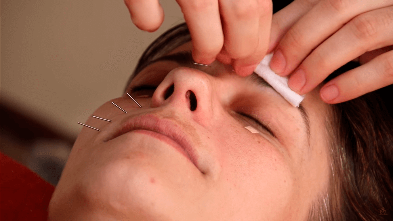 Acupuntura para mejorar la salud del rostro