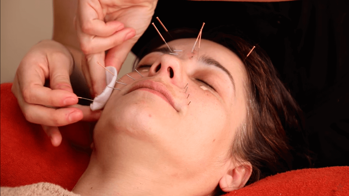 Terapia de acupuntura facial y kobido