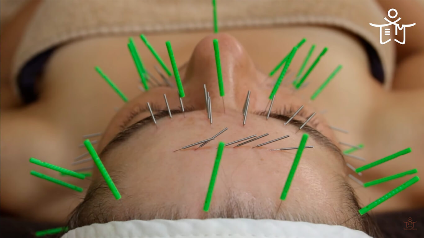 Cómo se realiza una terapia de acupuntura