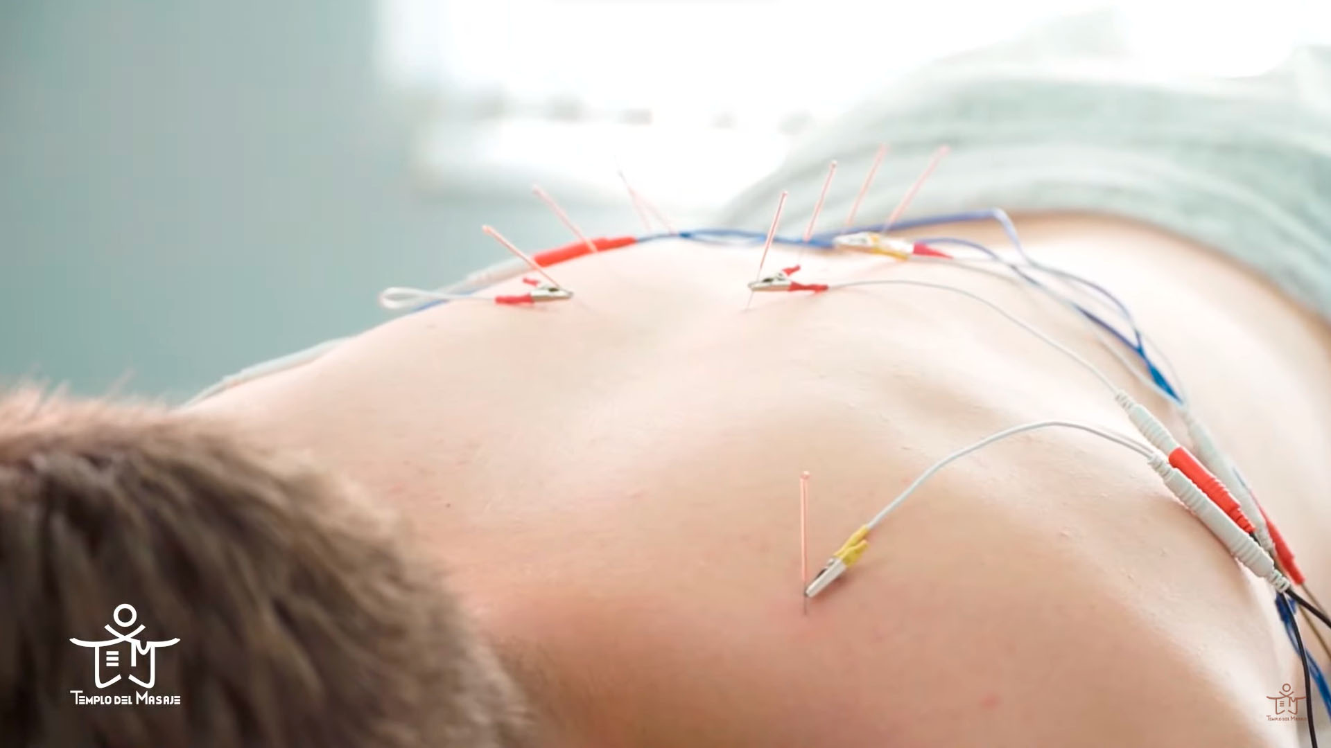 Cómo se realiza la acupuntura